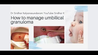 What is an umbilical granuloma How do we manage the umbilical granuloma umbilicalgranuloma [upl. by Goldsworthy]