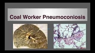 Pneumoconiosis Coal workers pneumoconiosis [upl. by Earised341]