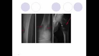 Multiple myeloma types diagnosis and its interpretation [upl. by Ruder]