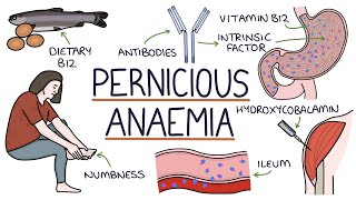 Understanding Pernicious Anaemia B12 Deficiency [upl. by Lertsek]