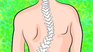 How to get rid of upper back scoliosis in 4 minutes a day [upl. by Alaunnoif195]