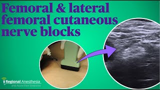 Femoral and lateral femoral cutaneous nerve blocks [upl. by Einnhoj]