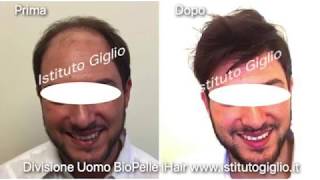 Perdita capelli la soluzione con BioPelle iHair di Istituto Giglio [upl. by Hegarty212]