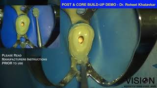 Post amp Core buildup [upl. by Aliahs60]