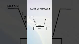 ulcer margin edge floor base surgery aiapget medical doctor medicine neet shorts [upl. by Lyrehc]