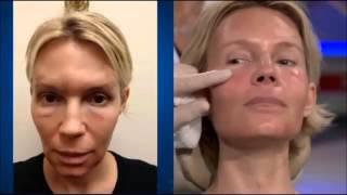 Dr Ourian Demonstrates Fractora  The Mini Face Lift [upl. by Aical216]