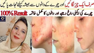 How to Completely Remove Acne Acne Scars and Pimples  100 Effective Results  Nadia [upl. by Hoashis]