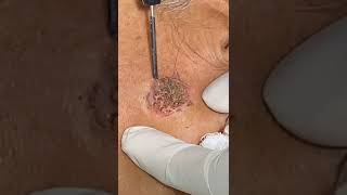 Seborrheic Keratosis at Skinaa clinic serborrheickeratosis skinaaclinic shorts createindia [upl. by Thin]