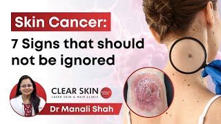 Skin Cancer 7 Signs that should not be ignored  Dr Manali Shah  Clear Skin Pune [upl. by Graniah734]