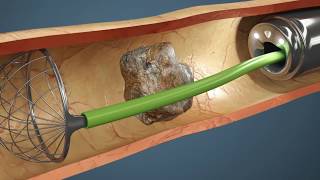 Como é feita a Cirurgia de Pedra nos Rins Vídeo da cirurgia em 3D [upl. by Maria]