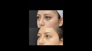 Under Eye Filler Treatment with PA Cathy  Ageless MD [upl. by Enimrac]