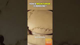 HOW A BRAIN TUMOR IS REMOVED shorts brain awesome [upl. by Assirroc991]