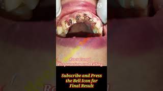 Root Canal Treatment  Teeth Reconstruction  Post and Core Build Up [upl. by Mariam511]