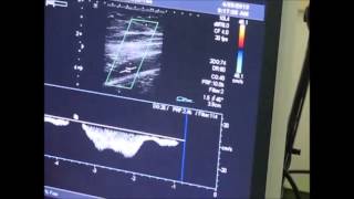 Femoral Vein Flow Using Duplex Ultrasound amp HandsFree Augmentation Device [upl. by Blunt193]