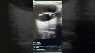 Reactive cervical lymph node reels ultrasound video neck nodes tb ultraradiology [upl. by Mehetabel]