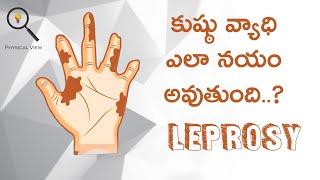 LEPROSY  కుష్ఠు వ్యాధి  LEPROSY IN TELUGU [upl. by Tnaryb234]