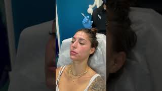 My First Lip Filler Experience at Plantation Med Spa Florida  Full Procedure on Camera shorts [upl. by Lucille]