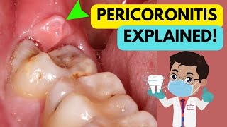 PERICORONITIS EXPLAINED IN 5 MINUTES CAUSE SYMPTOMS DIAGNOSIS AND TREATMENT [upl. by Wordoow]