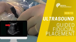 Ultrasound Guided Fiducial Placement for Stereotactic Radiotherapy [upl. by Kaia]