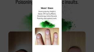 Common Nail Diseases You Should Know About NailHealthNailCareFungalInfectionNailPsoriasis [upl. by Wolfy877]