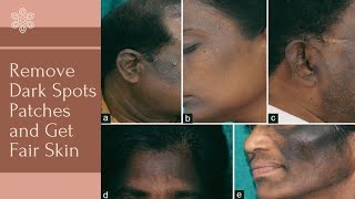 Remove Pigmentation Dark Black Patches Around Mouth Face Nose  M Laz Cream Use Benefits Hindi [upl. by Neleb361]