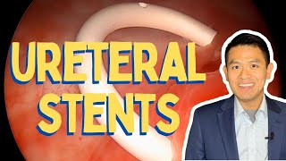 Ureteral Stent Insertion and Removal  Procedure in Detail [upl. by Dorran885]