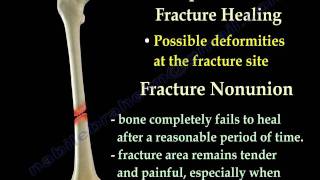 Fracture Healing Part 1  Everything You Need To Know  Dr Nabil Ebraheim [upl. by Sanyu215]