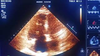 PHTNpulmonary hypertension lung cancer [upl. by Crellen]