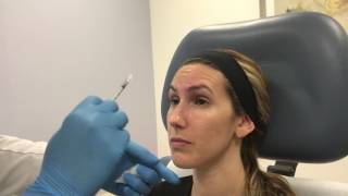 Dysport treatment for frown lines forehead lines and crows feet by Dr Shaun Patel  Miami FL [upl. by Dnalloh]