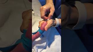 INFANT BABY IV LINE INSRATION 🩺health ivfluids injection youtubeshorts [upl. by Ycat]