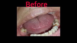 Full Mouth Rehabilitation fpd prosthodontic rct dentist dentalclinic toothcolouredprosthesis [upl. by Eeryt]