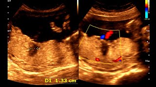 Placental Lakes  24 wks 4 days pregnancy  Normal pregnancy [upl. by Alyssa]