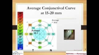 Fitting and Troubleshooting Scleral Lenses Part 1 [upl. by Nosyrb]