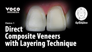 Direct Composite Veneers with Layering Technique using AMARIS  Operative Dentistry  VOCO GmbH [upl. by Boswell]