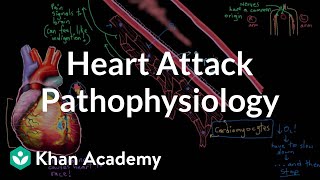 Heart attack myocardial infarction pathophysiology  NCLEXRN  Khan Academy [upl. by Eednas213]