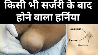 Incisional hernia इंसिज़नल हर्निया केसे होता है कारण लक्षण और इलाज surgeryday surgeryrecovery [upl. by Ronyar]