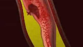 Myocardial Infarction Animation [upl. by Nnomae]