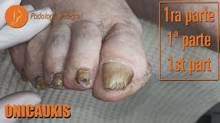 Onicauxis onychomycosis amp callosities Part 1 podologiaintegral [upl. by Nnylahs380]