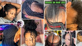 HAIR LOSS AMAZING HAIRSTYLES IDEAS FOR BLACK WOMENALOPECIA BRAIDS HAIRSTYLES [upl. by Almena]