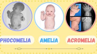 ACROMELIA  PHOCOMELIA  AMELIA  SHORT LIMB ABNORMALITIES  CONGENITAL MALFORMATION [upl. by Aerdnaxela]