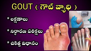 GOUT Causes Symptoms and Treatment in Telugu [upl. by Romelda349]