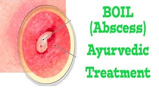 Best Ayurvedic Treatment For Abscess Boils  Dr Abrar Multani [upl. by Forta905]