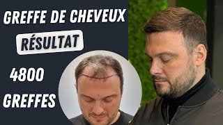 Résultat de la greffe de cheveux 4800 greffons l Avant et après l Greffe de cheveux en Turqui [upl. by Ydderf789]