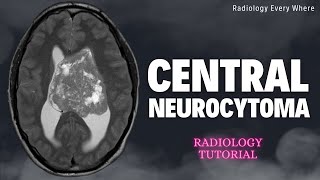 Central Neurocytoma Radiology Tutorials [upl. by Reisch]