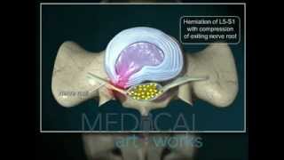 3D Medical Animation  L5S1paracentraldischerniation with compression of nerve root [upl. by Arob751]