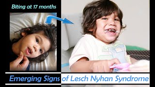 Early Emerging Signs of Lesch Nyhan Syndrome in DaveyBiting Started at 17 months [upl. by Link104]