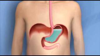 Heartburn Acid Reflux GERDMayo Clinic [upl. by Dnalkrik]