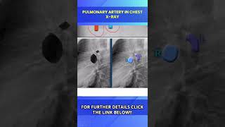 Chest X Ray Lateral View Normal amp Positioning Chest X Ray Kaise Hota Hai [upl. by Asiar]