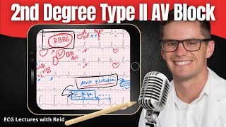 Second Degree Type II AV Block EKG  ECG Lecture [upl. by Francesco]