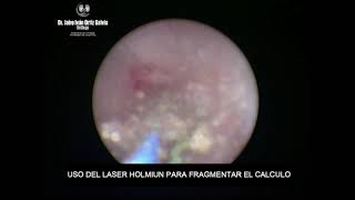 LITOTRICIA LASER EN CALCULO URETERAL DERECHO 2 [upl. by Rhtaeh263]